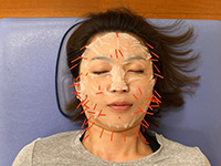 美顔鍼(幹細胞美容鍼)